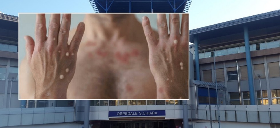 Vaiolo delle scimmie, c'è il secondo caso in Trentino: il paziente si trova in isolamento nella propria abitazione
