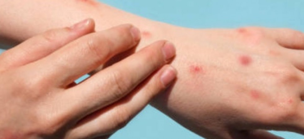 Vaiolo delle scimmie, salgono a 662 i casi confermati: sono dieci le donne contagiate