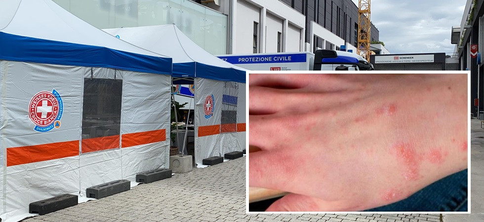 Epidemia di scabbia in carcere, è allarme