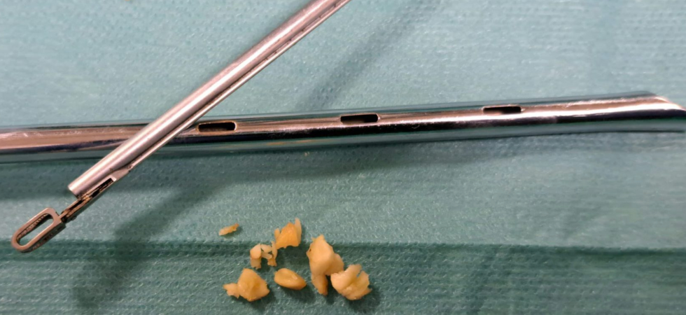Una nocciola nei bronchi per due settimane: bambina altoatesina di 20 mesi salvata a Treviso